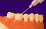 Atridox being injected into periodontal pocket