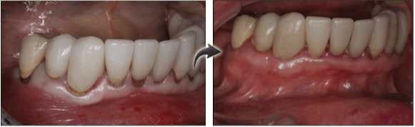 New Jersey patient before and after gum grafting