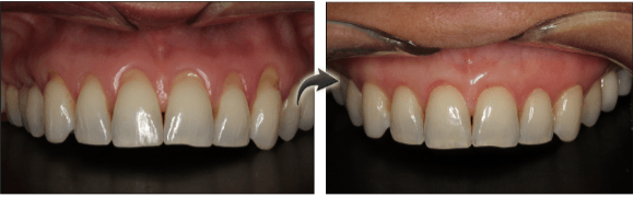 New York City patient before and after gum grafting