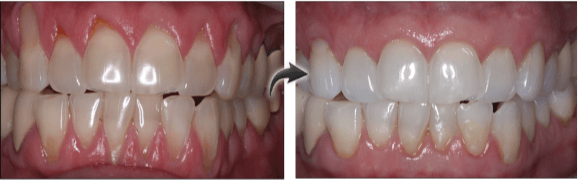 Long Island patient before and after gum grafting