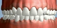 Illustration of Mouth after Gum Grafting in NYC