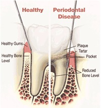 Signs & Symptoms of Periodontal Disease