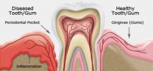 Best Periodontal and Gum Disease Treatment NYC
