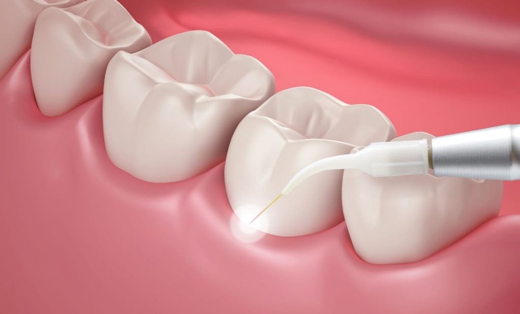 Laser Gum Surgery LANAP Versus Traditional Gum Surgery Laser