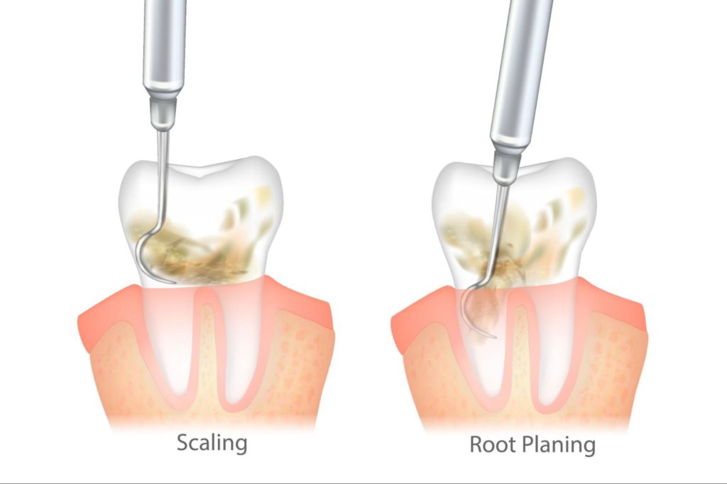 diagram of scaling and root planning on a tooth