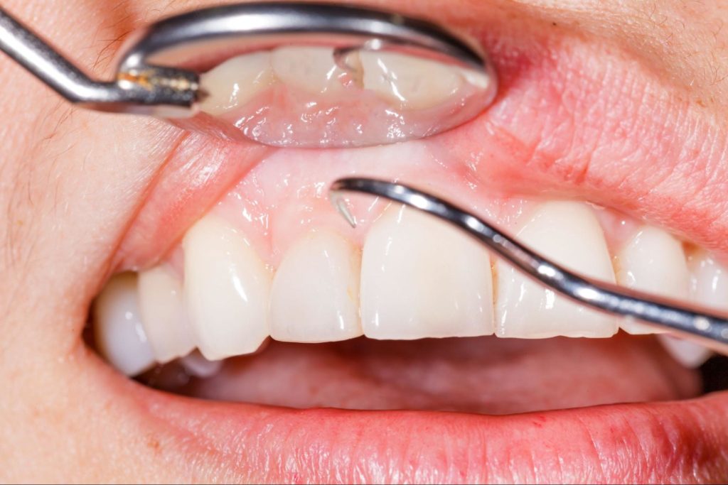 Close up of the mouth of a patient receiving gum care