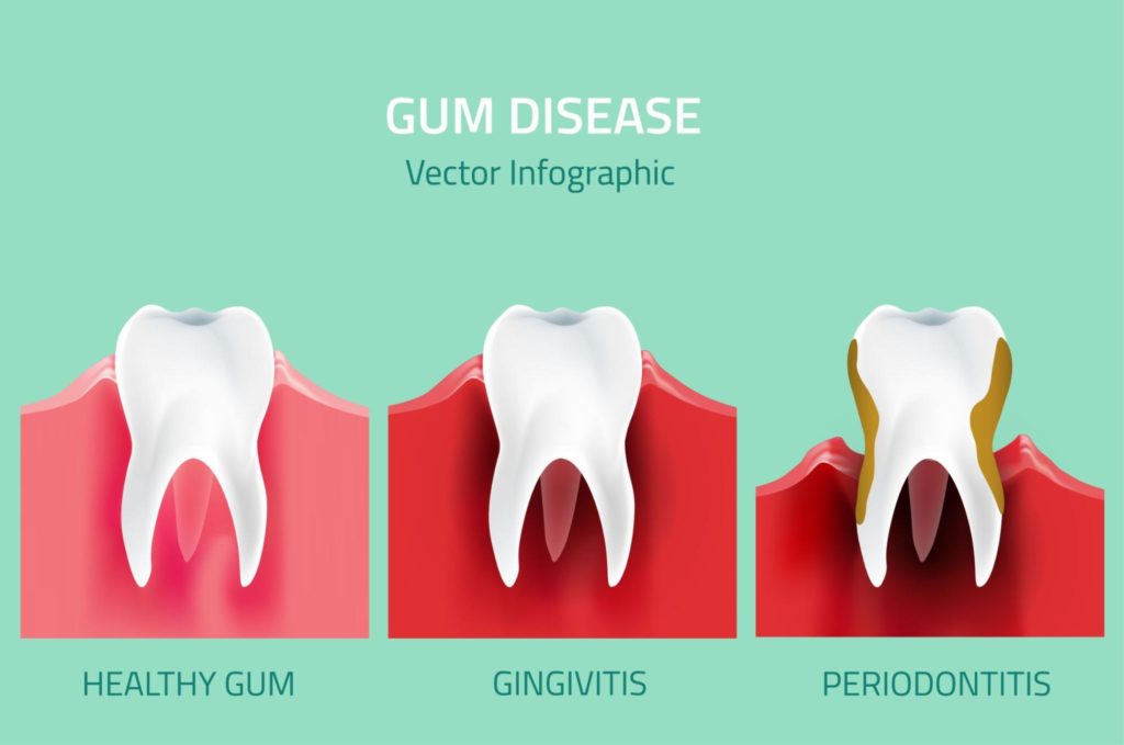 drawn diagram of teeth with gum disease