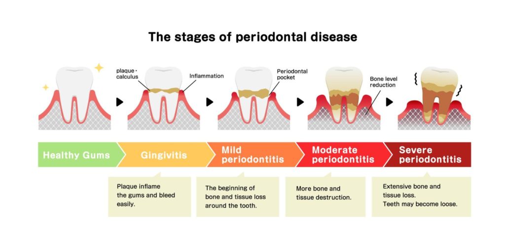 Diagram showing the different stages of periodontal disease