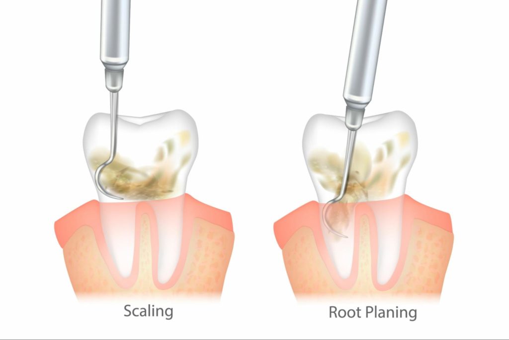 Diagram of scaling and also of root planning, a dental technique