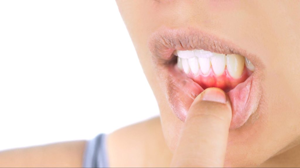 woman with gum disease below her teeth