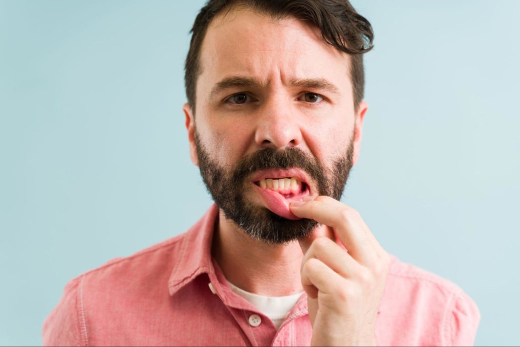 Man showing his lower gums with visible inflamation and gingivitis