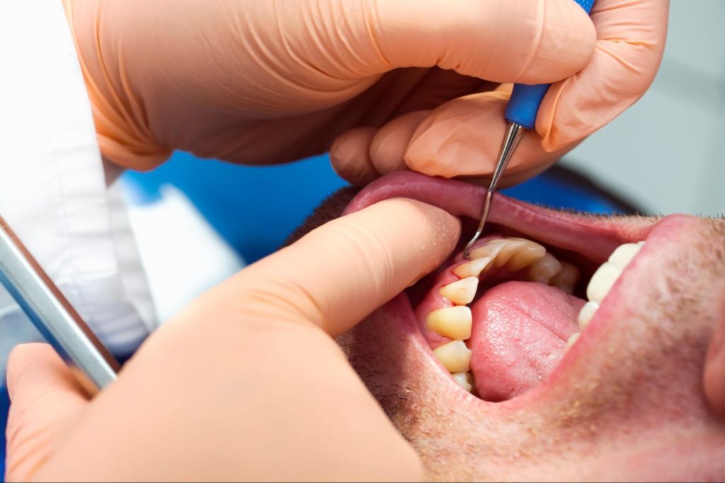 dentist examining a patient's open mouth