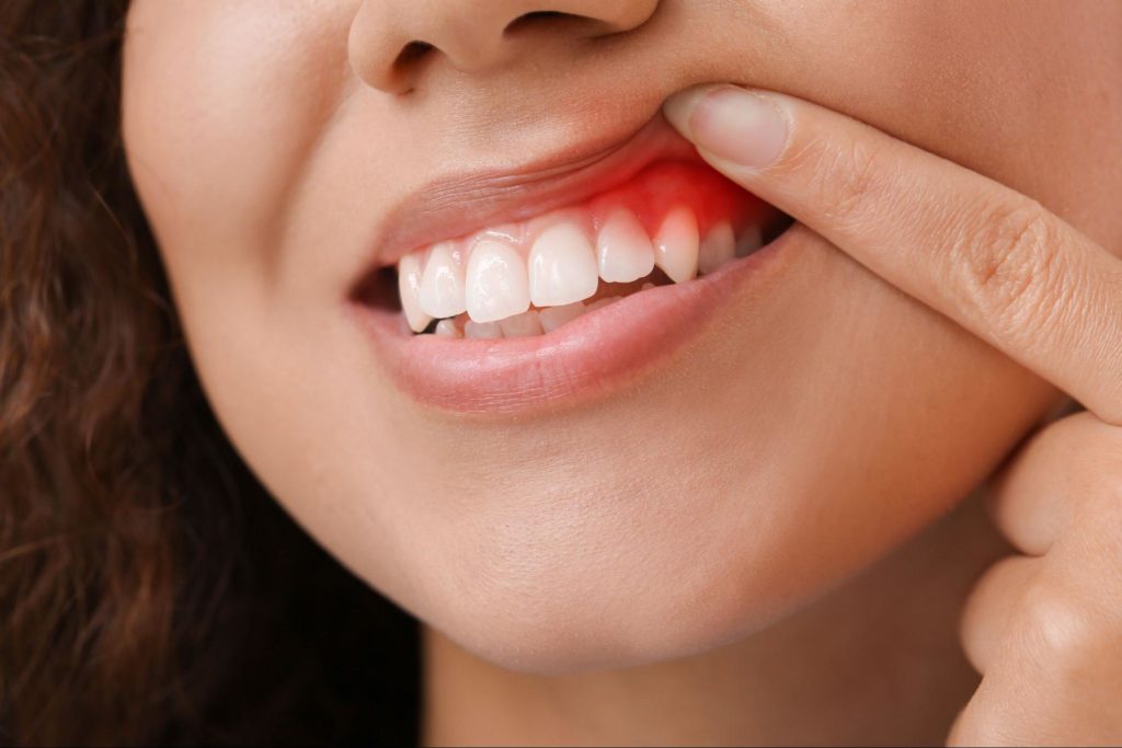 Women raising the top of her gums with her finger to show red, inflamed gums.