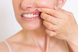 Gum Disease Symptoms: Redness