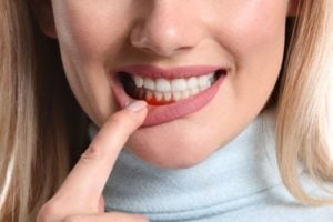 Signs And Symptoms Of Periodontal Disease