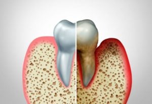 The Stages of Gum Disease