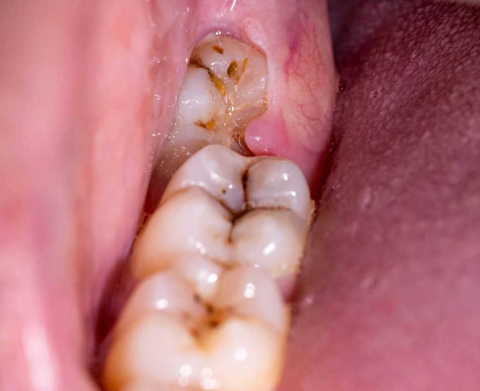 Pericoronitis