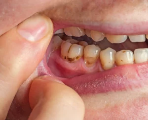 Gumline cavities