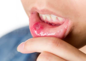 Canker sore