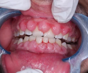 Gingival Hyperplasia