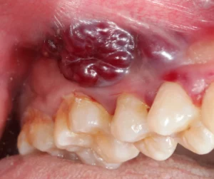 Gum Cancer