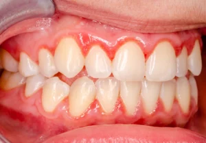 Plasma Cell Gingivitis