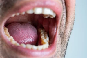 Sjögren’s Syndrome